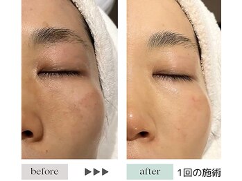 ジェニックサロン グランギンザ 水戸(GENIC SALON GRAND GINZA)/最新リフト/シミ/赤み/くすみ