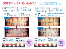 ホワイトニングショップ 多摩店の雰囲気（当サロンお客様の症例です★食事・喫煙制限なし♪）