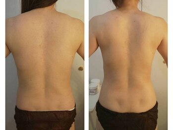 ミロク(MIROKU.)/REVIハーブピーリング　背中ケア