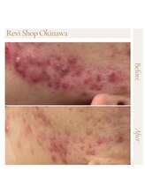 ルヴィショップ 沖縄(REVI SHOP)/ニキビへアプローチ