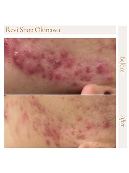 ルヴィショップ 沖縄(REVI SHOP)/ニキビへアプローチ