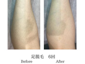 ミーシェ(Meshie)/足脱毛　施術前後
