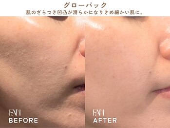 ファン(FAN)/グローパック BEFORE-AFTER