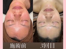 ウィズルーチェ 麻布十番店(with luce)/３０代　肌改善　３ヶ月