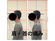 カワル整体 長嶺院/首・肩の痛み