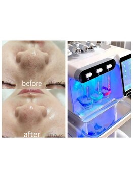 毛穴ケアをしたい