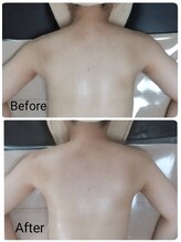 プレマータ(Prema-ta)/ビフォーアフター♪(施術1回)