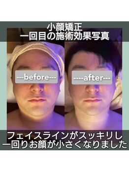 ココロ(cocoro)/小顔フェイシャル１回の変化