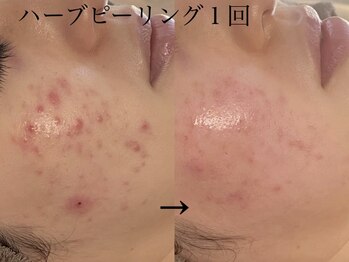 シュリー(Sriii)/ハーブピーリング1回