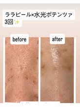 サロン コト(Salon Coto)/ララピール×水光ポテンツァ