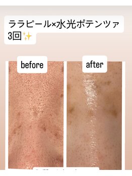 サロン コト(Salon Coto)/ララピール×水光ポテンツァ