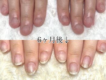 深爪矯正 爪悩み専門店 cocomo/(深爪/長さだし/フィルイン)