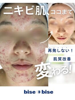 ビズビズ 天王寺店(bisebise)/5~10年長年のニキビ悩みの方へ