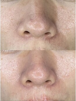 コルハ(CoLHa)の写真/都度払い脱毛×最新ララピールのWアプローチ！産毛も角質も徹底ケアして、黒ずみのない水光肌へ♪
