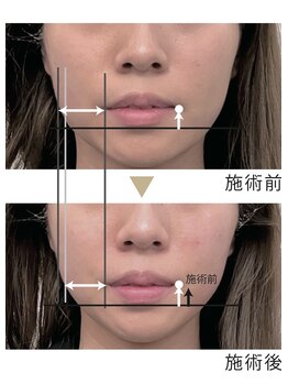 エムドット(M.)/たるみケアにはエアバリ★