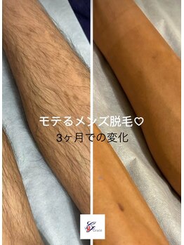 グレース(Grace luxe)/メンズ脱毛LINEからのみ受付中☆