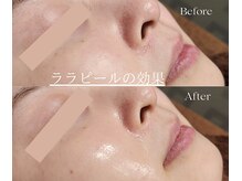 脱毛サロン ベル(Bell)/ララピール★