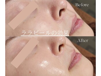 脱毛サロン ベル(Bell)/ララピール★
