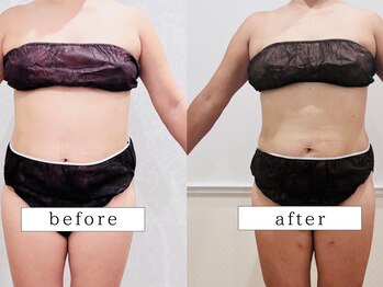 ビューティズムラウンジ(Beautism Lounge)/ボディー　お腹