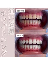 エクシアホワイトニング 武蔵小杉店/ビフォーアフター