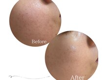 滑らかたまご肌コース【赤み・毛穴・自分肌の観察力を養う】