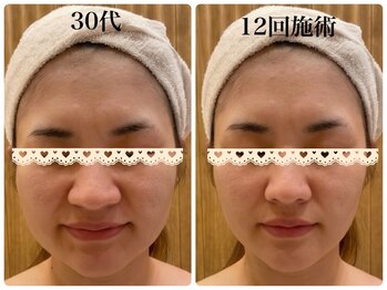 エピファニー(Epi phany Total Beauty Salon)の写真/ほうれい線・たるみ改善に！ハイパーEXで深部温熱☆デコルテ首肩から整え、理想の輪郭へ◎