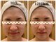 エピファニー(Epi phany Total Beauty Salon)の写真/ほうれい線・たるみ改善に！ハイパーEXで深部温熱☆デコルテ首肩から整え、理想の輪郭へ◎