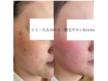 リライズ 磐田(Rerise)/ADSサロンケア