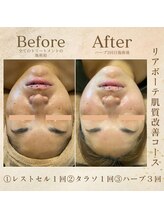 エソール(essor)/フェイシャル改善トリートメント