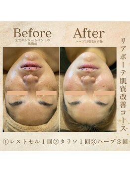 エソール(essor)/フェイシャル改善トリートメント