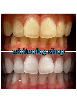 ホワイトニングショップ 郡山店/妊娠中でも施術可能♪