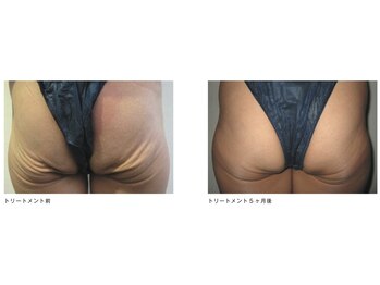 Nビューティー/最新RFサーモシェイプオーパス