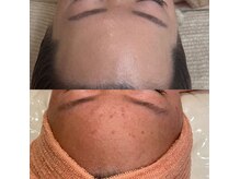 ジャストミービューティー(Just Me Beauty)の雰囲気（ずっと繰り返していたニキビに！リアボーテハーブで艶肌に★）