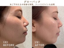 ファン(FAN)/グローパック BEFORE-AFTER