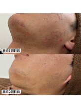 アエオボンヌール(A.E.O BONHEUR)/赤み ニキビ 毛穴