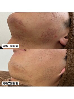 アエオボンヌール(A.E.O BONHEUR)/赤み ニキビ 毛穴