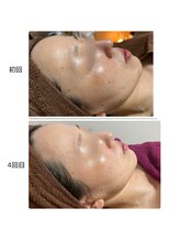 ヴィヴィエ 佐賀店(ViVier)/ララピール　症例4回