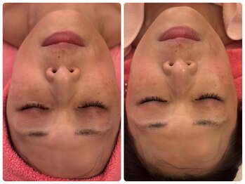 サロンドデュイ/1回施術/50代/たるみケア/くすみ