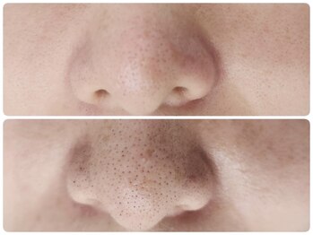 ナチュローズ新小岩/毛穴ケアハイドロスプラッシュ