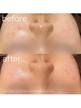 ルルラ リコ(lulula rico)/症例写真/ハーブピーリング