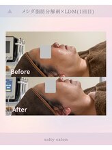 ソルティ サロン(salty salon)/脂肪分解メシダ