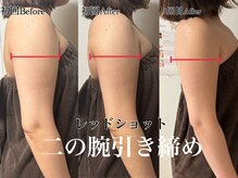 アンドエス 六本木(and S.)/回数を重ねて二の腕スッキリ♪