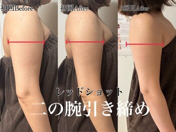 アンドエス 六本木(and S.)/回数を重ねて二の腕スッキリ♪
