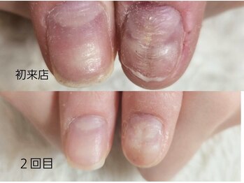 グラシナ 名古屋金山店/(深爪／長さだし/フィルイン)