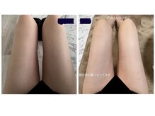 フォーユー整骨院 中島院(foryou整骨院)/浮腫みが気になる人はラジオ波！