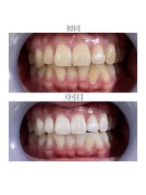 ホワイトニングショップ 静岡店/ホワイトニングBefore→After