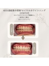 プラスビーセルフ(+b self)/ホワイトニングビフォーアフター