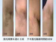 アンジェリーナ/男性/脇脱毛/ビフォア