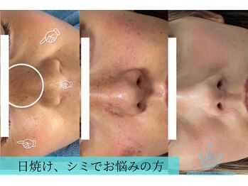 リメイクビューティークリニック(REMAKE BEAUTY CLINIC)/幹細胞ゴールドピーリング