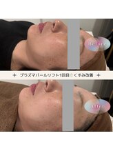 ディアー(Dear)/プラズマパールリフト